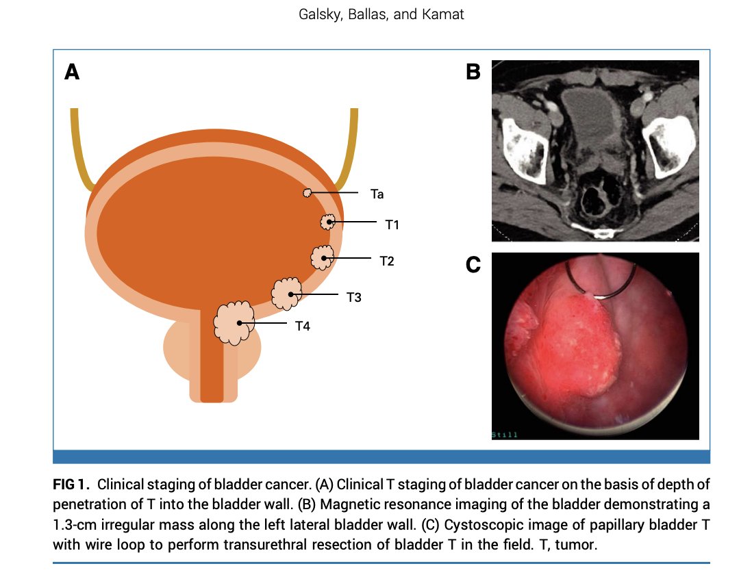 DrYukselUrun's tweet image. A mind-opener review on muscle-invasive bladder cancer. Must-read for GU oncologist.
#BladderCancer #Oncology #Immunotherapy
@MattGalsky  @l_ballas @UroDocAsh @ASCO @JCO_ASCO @WorldBladderCan @OncoAlert @OncBrothers @Uromigos @urologysummit 
doi.org/10.1200/JCO-25…