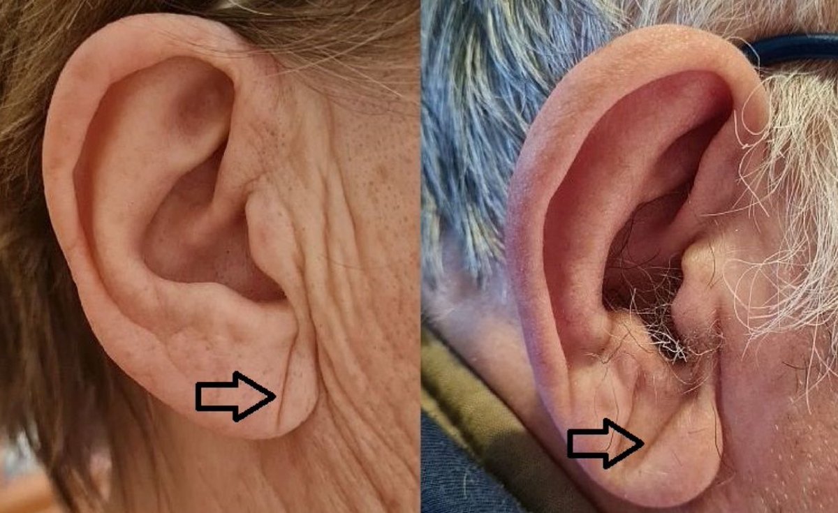 Mais um caso de semiologia romântica: o sinal de Frank.

Um alerta para você não utilizar um achado espúrio para suspeitar de uma doença grave junto com um passeio pela semiologia baseada em evidências. 🧶

Imagem: J Clin Med. 2021 Jun 25;10(13):2799.