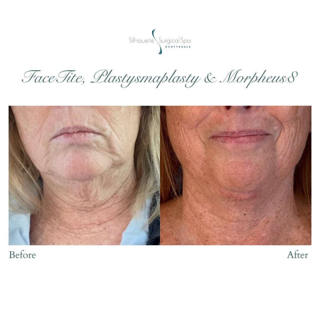 surgicalspa's tweet photo. Stunning transformation with FaceTite, Morpheus8 &amp; a Plastysmaplasty

This combo tightens, lifts &amp; defines for a refreshed, natural look. Ready for your glow-up?

📍Scottsdale, AZ
📞 (480) 451-9220
🔗 https://t.co/5LIgWR4U03
#FacialRejuvenation #FaceTite #Morpheus8 #drptak https://t.co/UQw91nxblZ