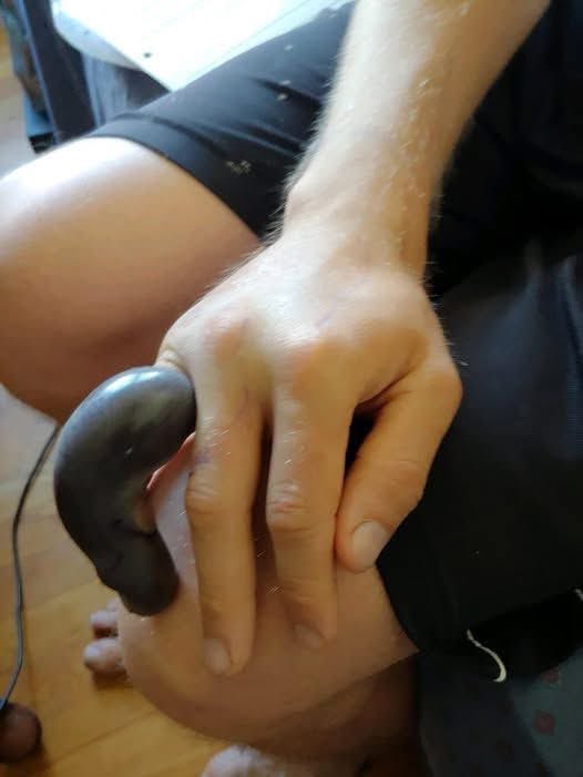 A finger after a copperhead bite