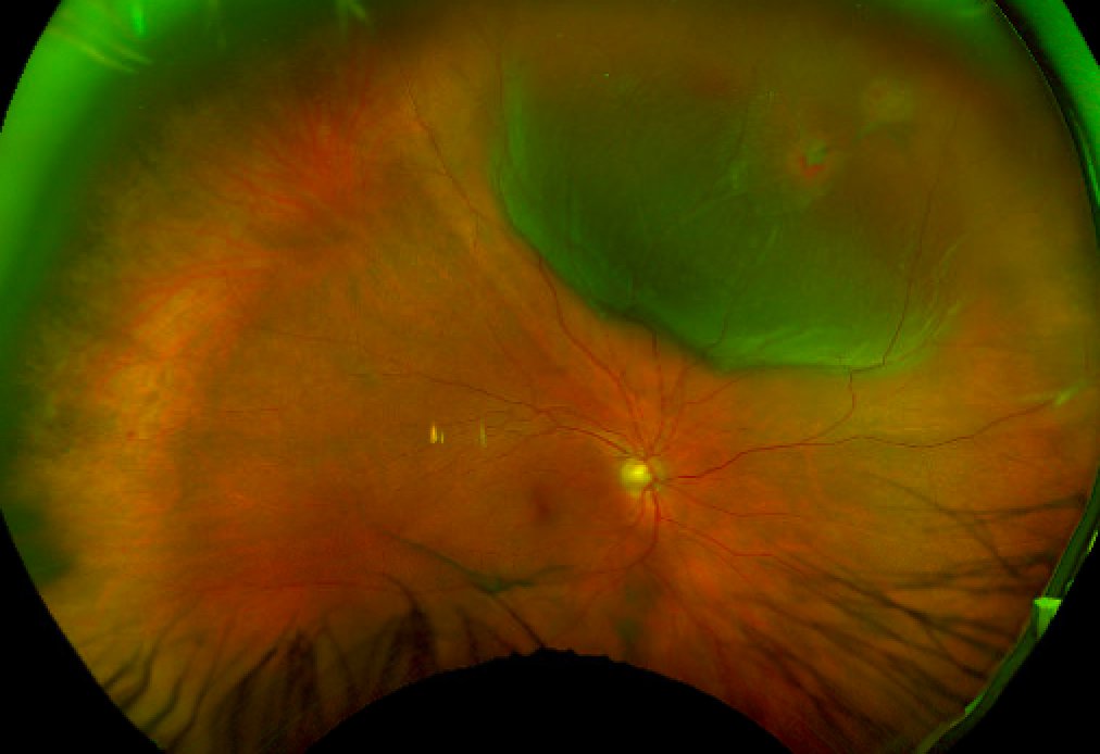Macula on rhegmatogenous retinal detachment with mild vitreous hemorrhage inferiorly. Note two retinal breaks.