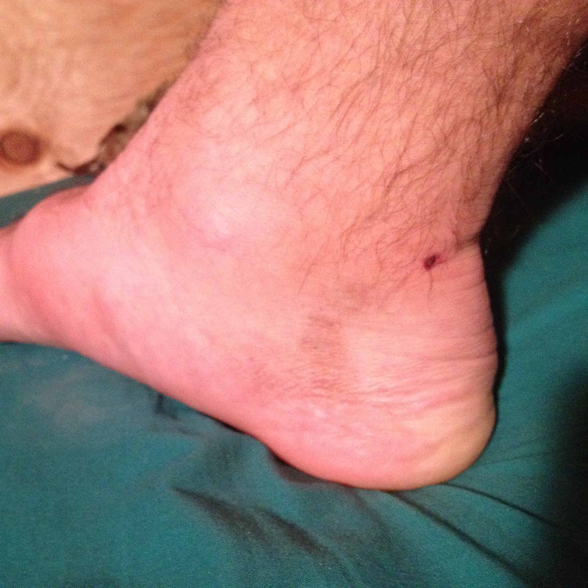 Happy National Purple Heart Day

Really glad the Russians make crappy grenades and Afghani’s can’t throw very well.

(My feet were ugly before getting “blown up”)