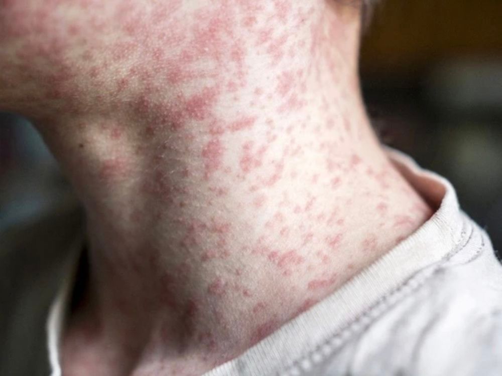 As of Wednesday afternoon, there are a total of 1,694 confirmed cases of measles in Alberta, eight of which are considered to be communicable

edmontonsun.com/news/local-new…