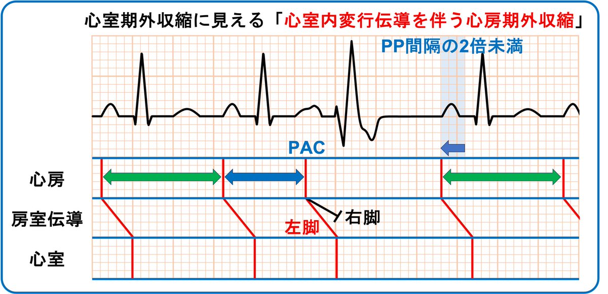 心室期外収縮にみえる心室内変行伝導を伴う心房期外収縮