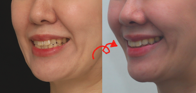 dds_cozy's tweet image. たまの投稿。
 鎖骨骨折リハビリ中につき、新患さんはお受けできません

今回は、笑顔で鼻翼基部が凹んだり、下の前歯が見える状態を改善する方法について

1️⃣ 鼻翼基部はプレートで前方に出して支える
2️⃣ 矯正は非抜歯で、強めアンカーを使って拡大＆圧下…