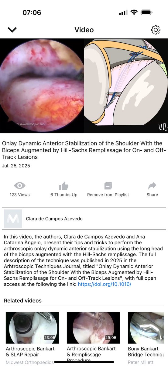 Clara Campos Azevedo, MD, PhD (@c_l_a_r_a_az) on Twitter photo Check out our tips and tricks to perform the arthroscopic onlay DAS using the long head of the biceps augmented with the Hill-Sachs remplissage at vumedi.com/video/onlay-dy…
Full technique published in the <a href="/ArthroscopyJ/">Arthroscopy Journal</a> at doi.org/10.1016/
<a href="/angelo_catarina/">Ana Catarina Ângelo</a>
<a href="/shoulderptuga/">SHOULDER.PT</a> Check out our tips and tricks to perform the arthroscopic onlay DAS using the long head of the biceps augmented with the Hill-Sachs remplissage at vumedi.com/video/onlay-dy…
Full technique published in the <a href="/ArthroscopyJ/">Arthroscopy Journal</a> at doi.org/10.1016/
<a href="/angelo_catarina/">Ana Catarina Ângelo</a>
<a href="/shoulderptuga/">SHOULDER.PT</a>