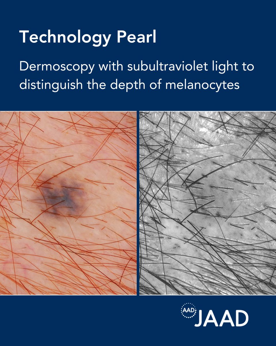 Accurately gauging melanocyte depth is key to distinguishing benign vs malignant lesions, but conventional dermoscopy can be challenging. Authors highlight sub-UV reflectance dermoscopy (sUVRD) as a proven tool for improved melanoma detection: bit.ly/4mVg3wQ