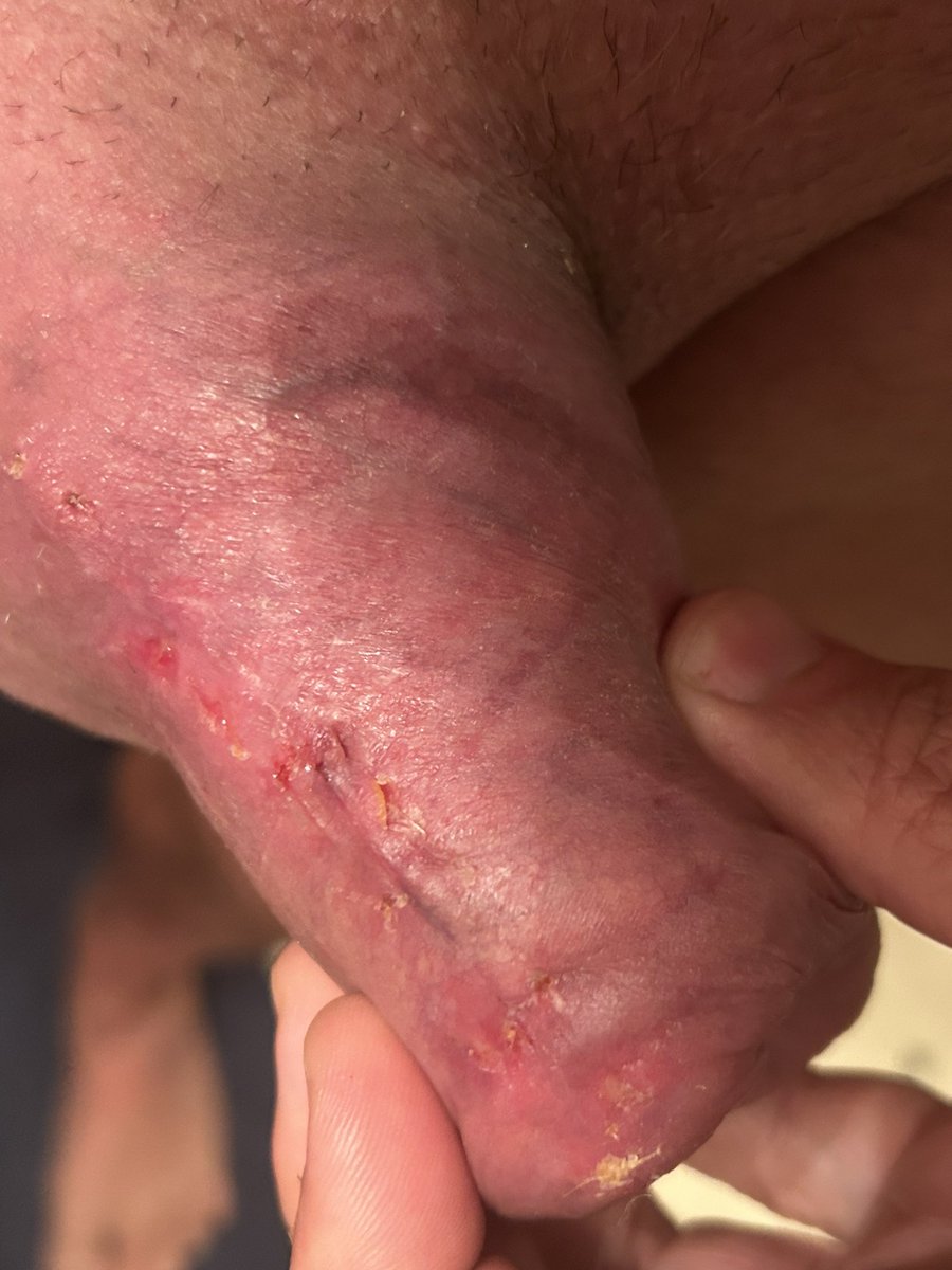 sexy_Cdn's tweet photo. Three weeks later, this is how my silicone be-bulking looks.  Stitches haven’t dissolved yet and still have some healing to do, but things are looking pretty good. I just have to decide if I want to get a follow up procedure done and get more removed. https://t.co/4GMK6cdWCy