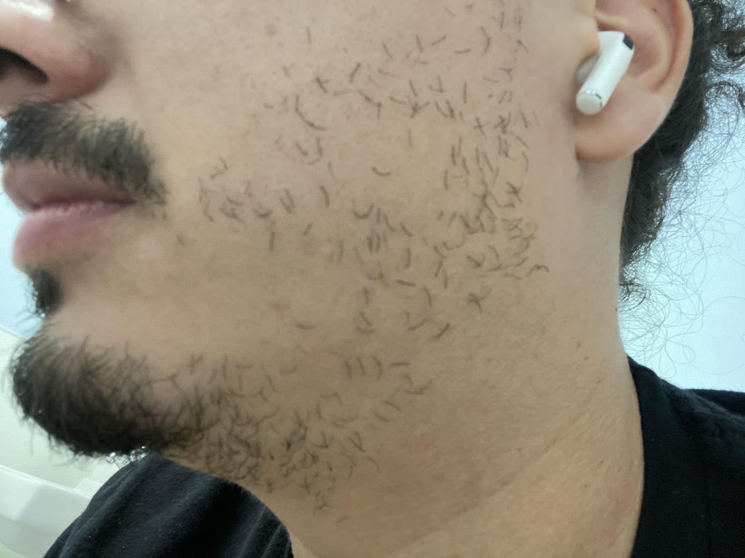 ThatCuck's tweet image. Beard is coming in nicely after my finasteride treatment