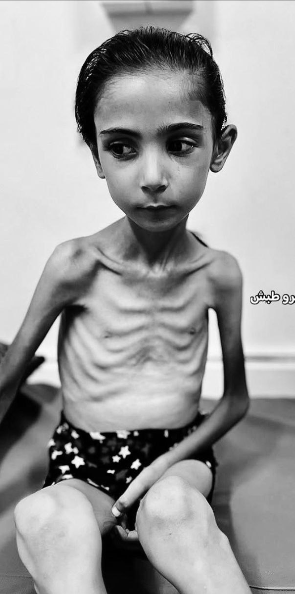 Esta niña no es una prisionera judía de Auschwitz o Treblinka. Se llama Amal, tiene 7 años y se encuentra el el campo de exterminio de Gaza.  
Los culpables de su estado no son los nazis alemanes, son los judíos de Israel.