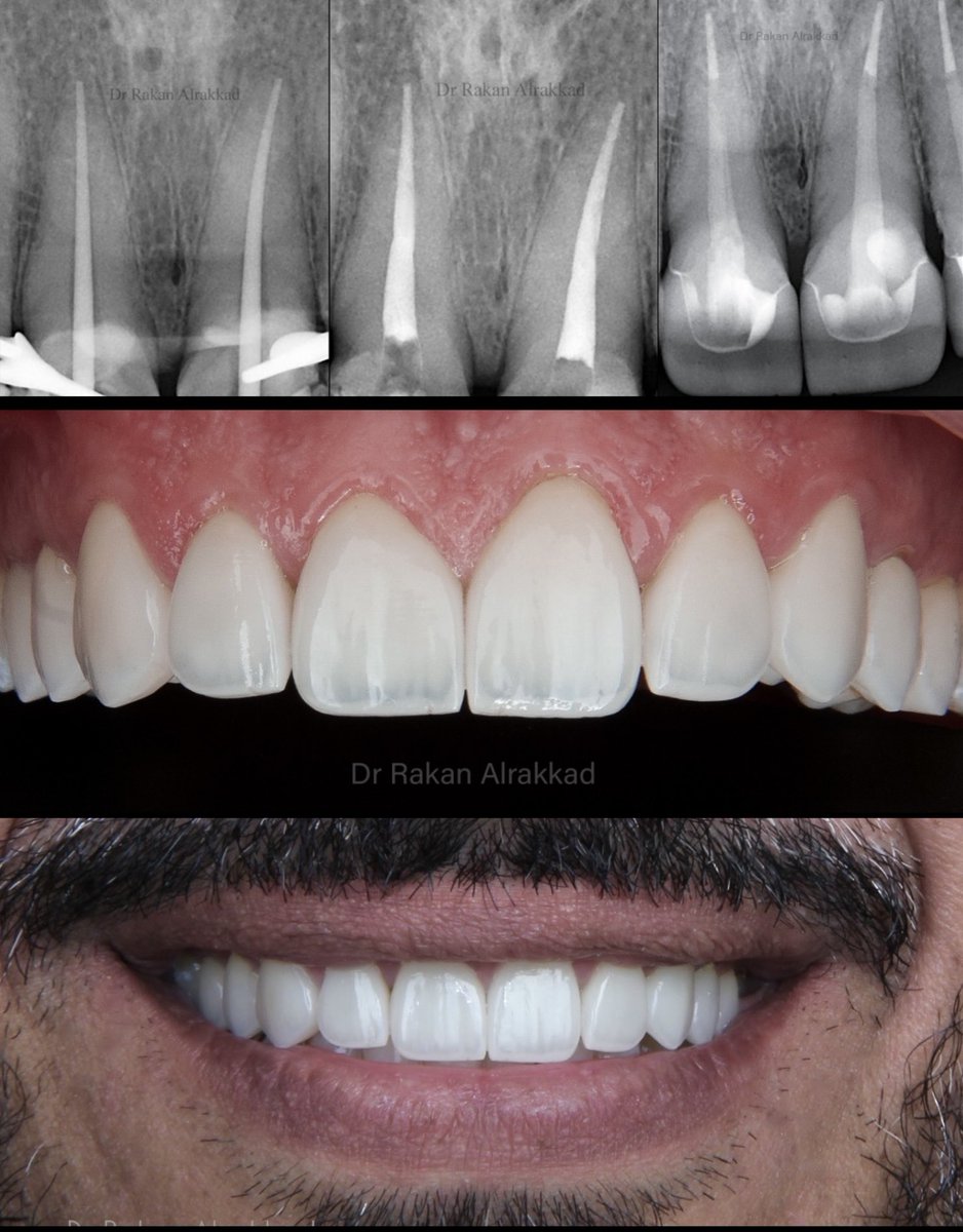 The small detail makes a difference 
Root canal treatment + post &amp; core 
E-MAX crowns 👑 

All procedures done under rubber dam 🦷