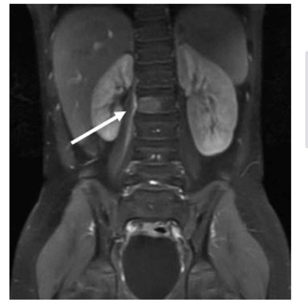 9 yaşında, önceden sağlıklı bir çocuk

4 gündür yüksek ateş (39.6°C)

Bel ve sağ yan ağrısı → yürürken aksama

CRP: 40 mg/L

BT &amp; USG: normal (taş / apandisit yok)

MRG: L2 vertebra + sağ psoas kasında tutulum

Evde kedi var.