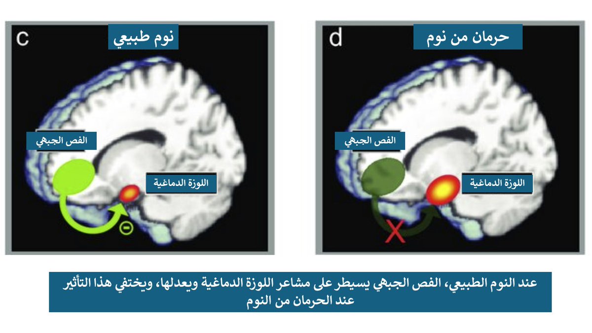 لماذا يفقد البعض السيطرة على مشاعرهم بعد ليلة بلا نوم؟
هل لاحظت يوماً كيف تتغير مشاعرك وقدرتك على اتخاذ القرارات بعد ليلة من الأرق؟ 😠 العلم يقدم تفسيراً دقيقاً لهذه الظاهرة!

🧠⚖️ التوازن المفقود في الدماغ..!

يكمن السر في مركزين رئيسيين بالدماغ يتأثران بشدة عند الحرمان من