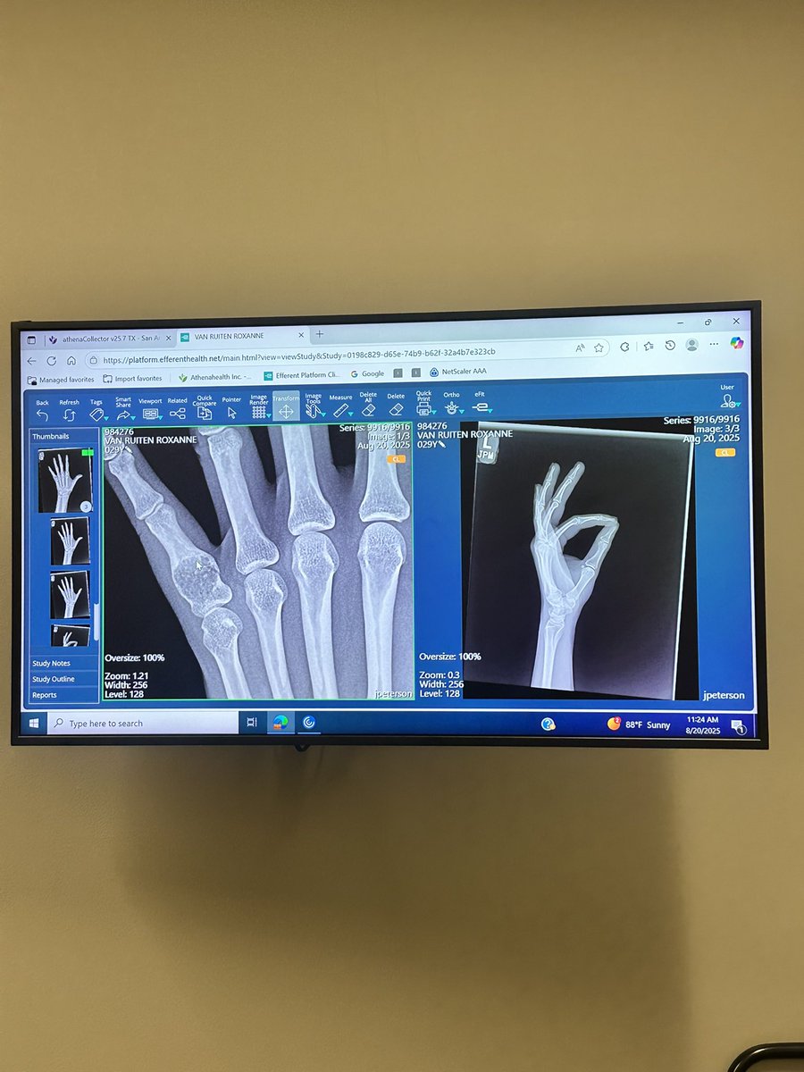 Broke my pinky today 😣 …same one I messed up a couple years ago, and here we are again. I’ll be stuck in a splint for the next few weeks &amp; eventually need surgery so it doesn’t keep breaking so easily. Thankfully I’m right-handed, but wow still so inconvenient 🥲