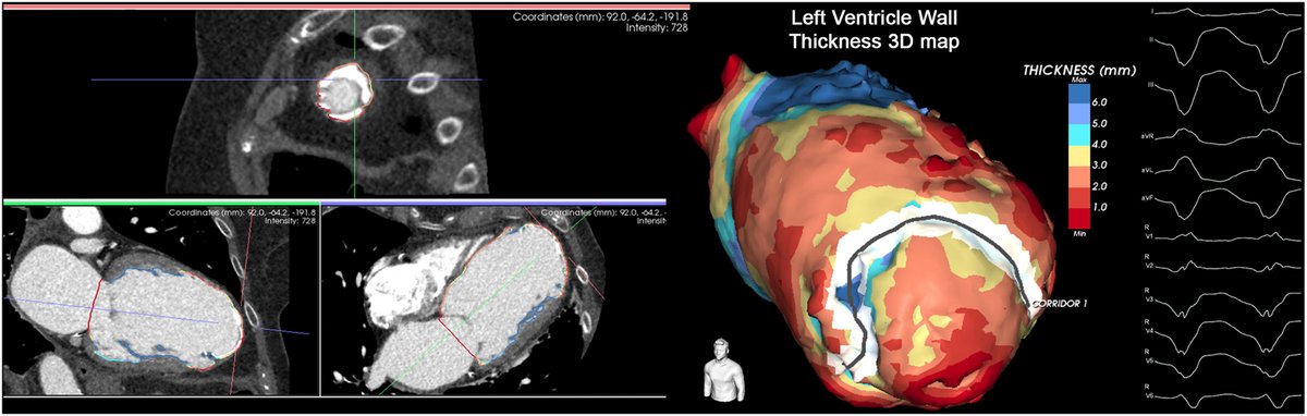 Multidetector computed tomography-integrated ventricular tachycardia ablation in a post-ischemic patient with apical aneurysm and extensive dystrophic calcification 
<a href="/ACLatini/">Alessia Chiara Latini</a> <a href="/diegopenela1/">diego penela</a> 
heartrhythmcasereports.com/article/S2214-…