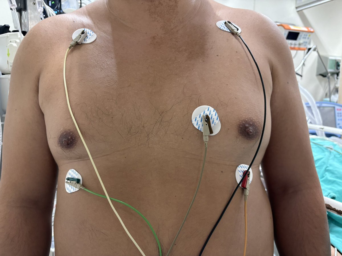 EmergPOCUS's tweet photo. 🖐️ Colocación correcta de los 5 electrodos ⚡️en el tórax 🫀Monitorización

              👇🏼 🧵 🪡 #HILO 🪡 🧵👇🏼

📌 En la configuración de 5 derivaciones, los #electrodos van así:
•🤍 Blanco: fosa infraclavicular, cerca del hombro derecho
•🖤 Negro: fosa infraclavicular, cerca del hombro izquierdo
•❤️ Rojo: debajo del reborde costal, lado izquierdo del abdomen
•💚 Verde (tierra/ground): debajo del reborde costal, lado derecho del abdomen (o en cualquier parte del cuerpo)
•🤎 Café: #precordial, habitualmente en V1 o V5

🙂 Esta disposición permite una monitorización más precisa y cercana al #electrocardiograma de 12 derivaciones.

Recuerda aquí la posición sí importa para obtener trazos claros y evitar diagnósticos erróneos.

#Monitorización #Electrocardiograma #ECG #Urgencias #CuidadosCríticos #POCUS #Emergencias #Electrodos #MedicinaDeUrgencias #PacienteCrítico #EducaciónMédica #Cardiología #MedicinaInterna #Residentes #TipsClínicos