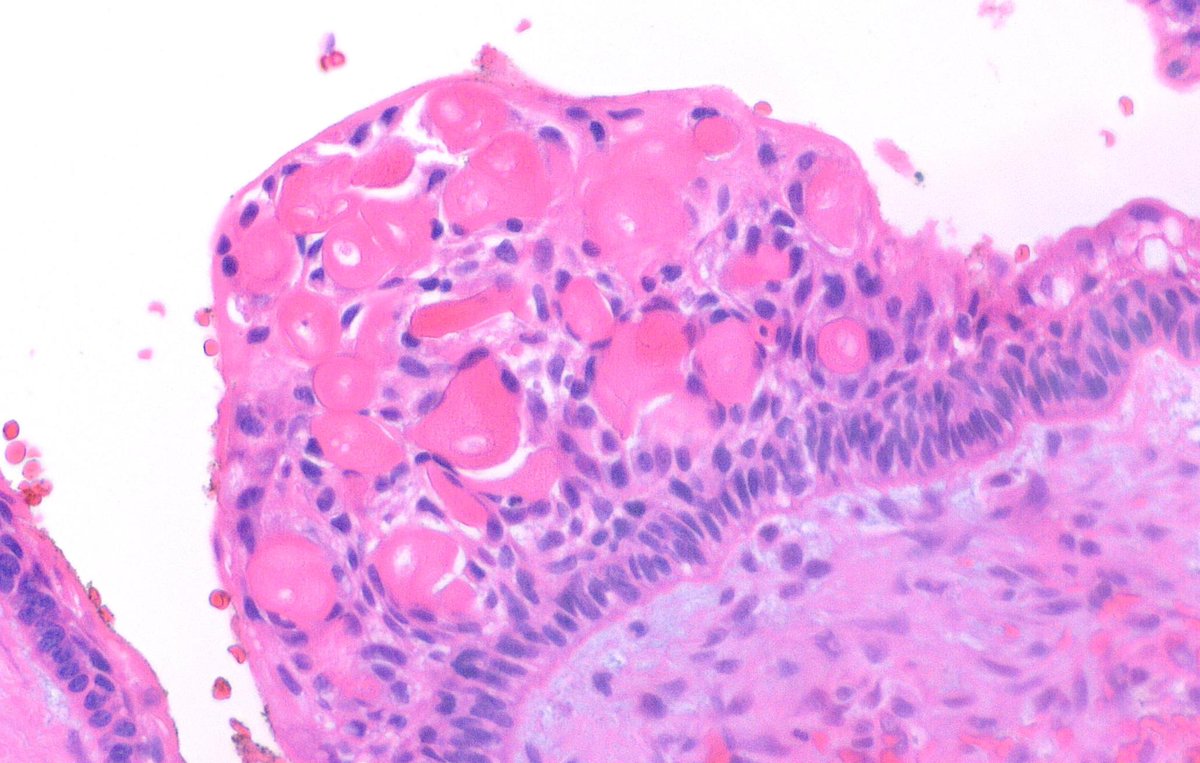 A 40-year-old female presented with a maxillary lesion. #oralpath #oralpathology #pathology #pathologists #pathTwitter #HeadNeckPathol #HeadandNeckPath #ENTPath #PathologyTweet