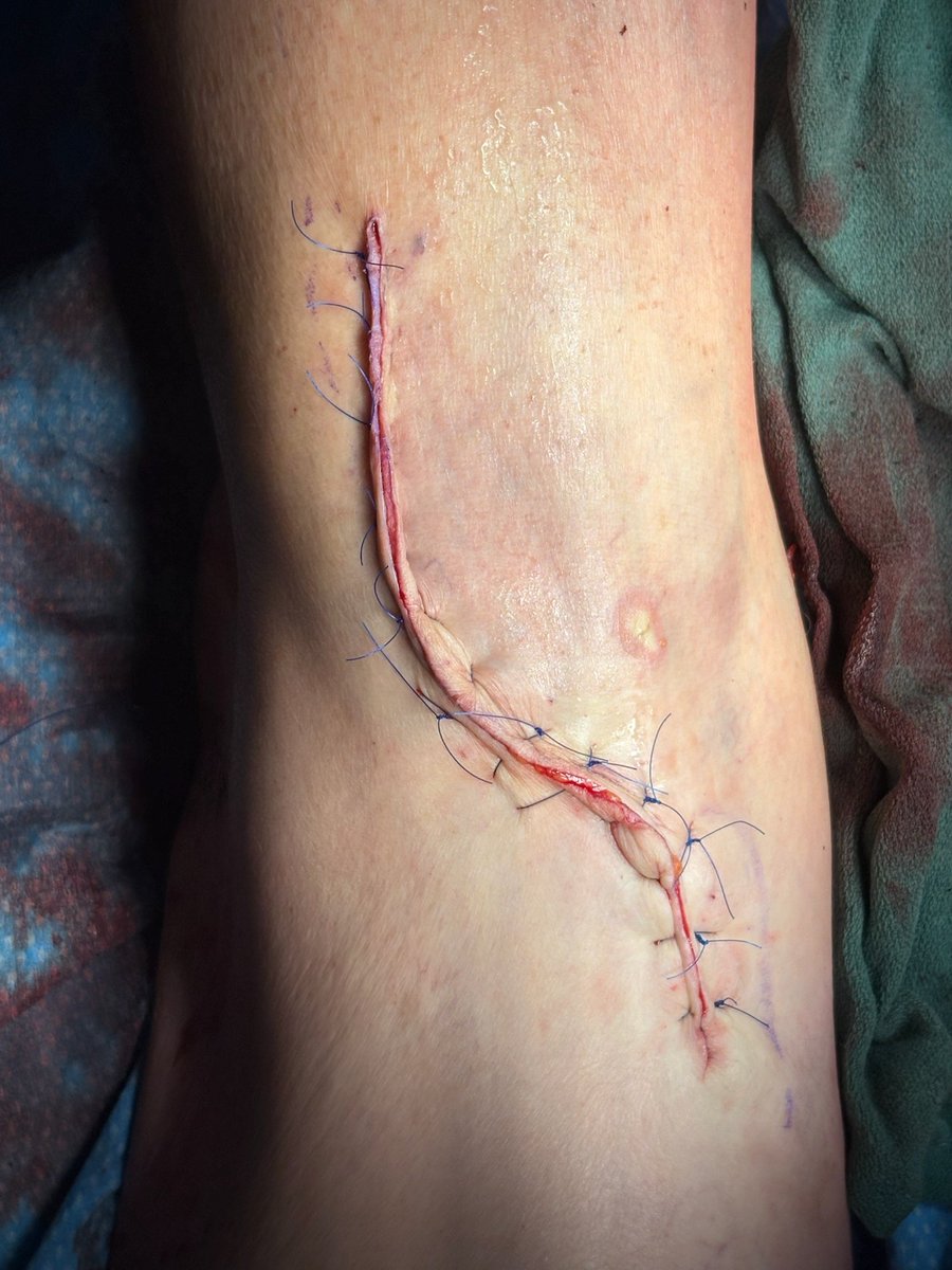 Sabalbal MD (@mahersabalbal) on Twitter photo Been a busy week. This large pop aneurysm was fixed via posterior approach: S curved incision prevents scar contractors of the skin. Superior longitudinal incision made on posteromedial aspect, horizontal through the flexion crease. <a href="/farkomd/">frank arko</a> <a href="/canuc_57/">Greg Hayes</a> <a href="/VascularSVS/">Society for Vascular Surgery</a> <a href="/jmills1955/">Joseph L. Mills MD</a> Been a busy week. This large pop aneurysm was fixed via posterior approach: S curved incision prevents scar contractors of the skin. Superior longitudinal incision made on posteromedial aspect, horizontal through the flexion crease. <a href="/farkomd/">frank arko</a> <a href="/canuc_57/">Greg Hayes</a> <a href="/VascularSVS/">Society for Vascular Surgery</a> <a href="/jmills1955/">Joseph L. Mills MD</a>