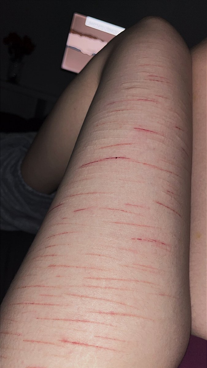 Idontexistx0's tweet photo. I forgot how good fresh razorblades hurt omfg (Ik its not much but I wasn’t sure how deep it would go since I haven’t used fresh blades in a long time) #shtwt #selfharm #scarspo #cutspo https://t.co/PsjICdYtjs