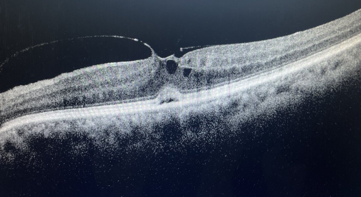 Diagnosis and Management ??

#Ophthalmology  #Retina #MedTwitter