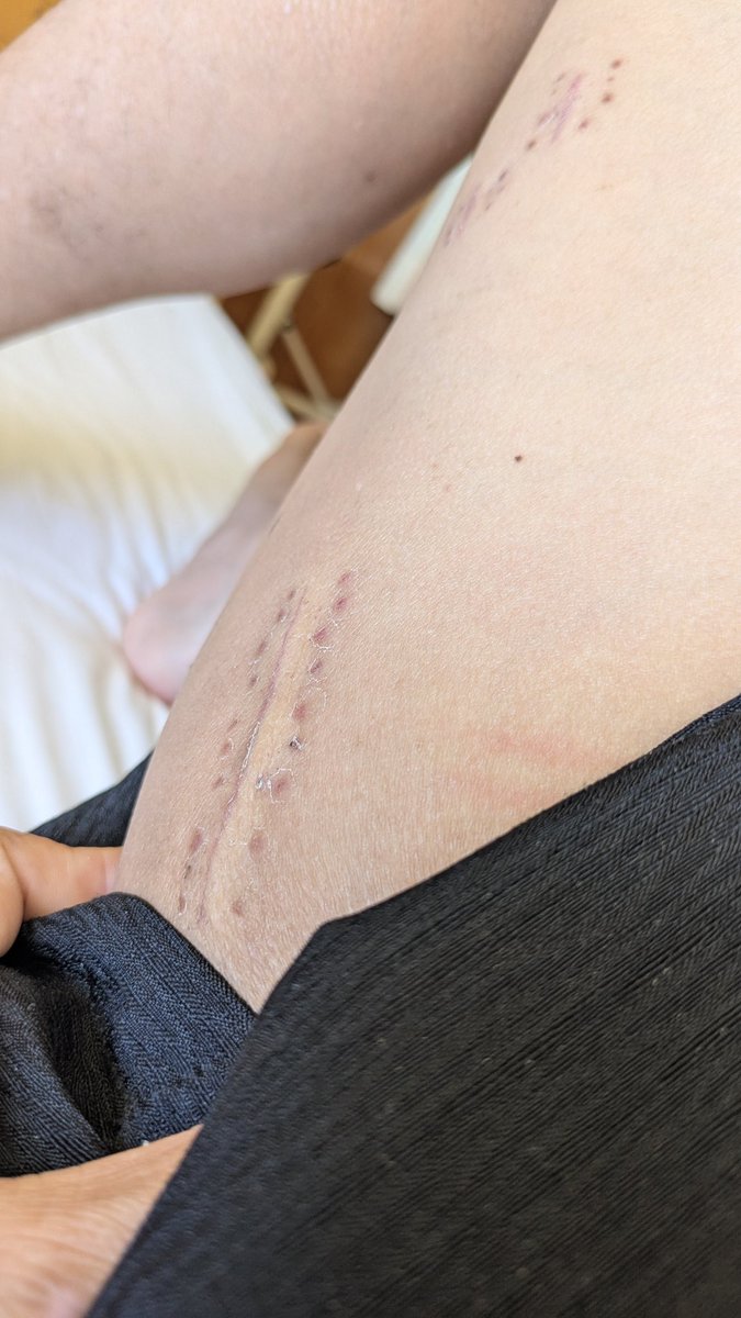 左の大腿骨に入れた金属板
1年後には外す又はそのままってのを決める必要があるけどどうしようかな(´ε｀；)ｳｰﾝ…
左脚の可動範囲が現状狭くなっているけどリハビリでどうなるのか分からないし外すなら手術を受けるならまた仕事を休む必要がある。
1年後までゆっくり考えるか