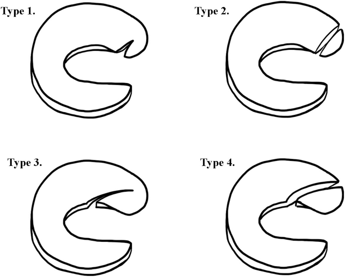 "Lateral Meniscus Oblique Radial Tears: A Review of Diagnostic Considerations, Biomechanical Impact, and Treatment Outcomes" Karom et al.

bit.ly/45xWHqJ