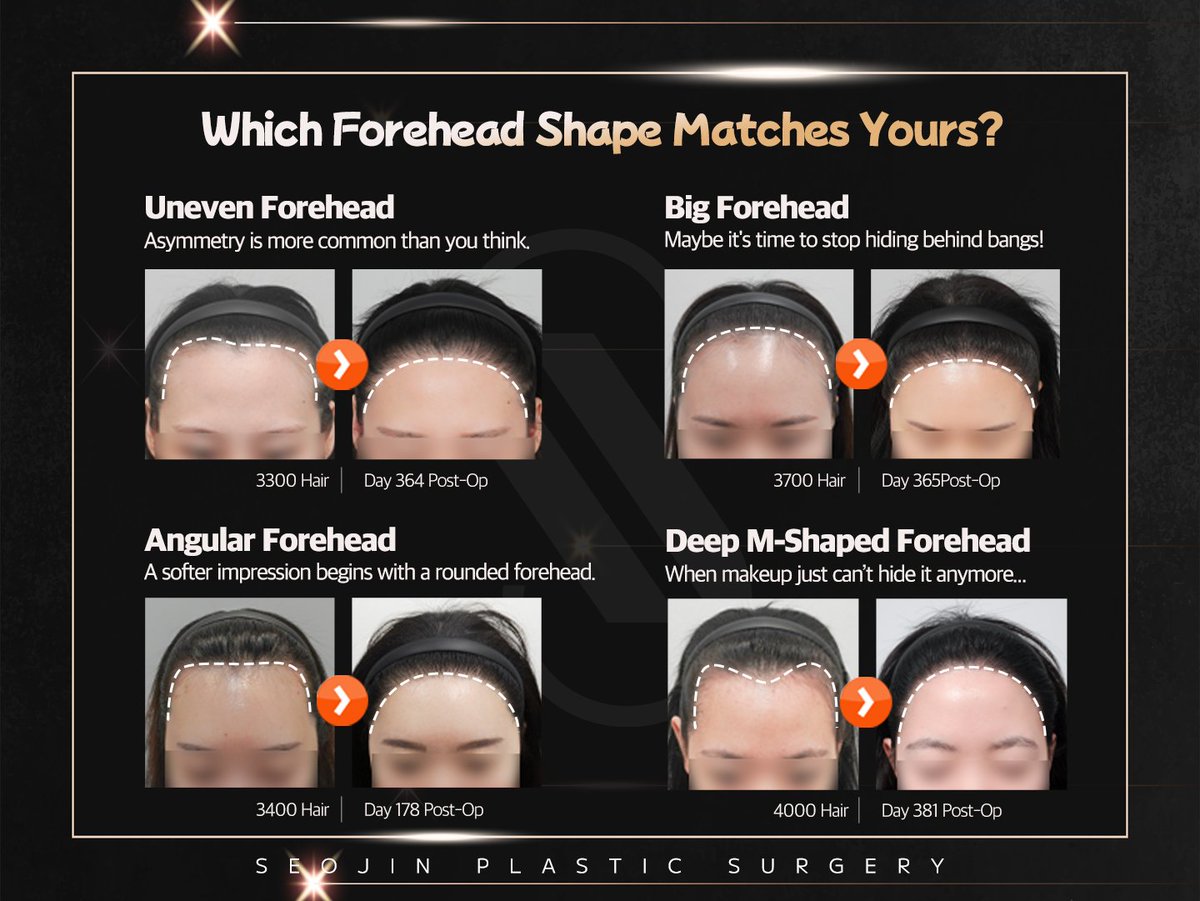 seojinps_eng's tweet photo. 🧐 “What’s your forehead type?”
Wide? Asymmetrical? Square shaped or deeply receding? Solve them all with a Korean-style hairline transplant!
#HairTransplant #ForeheadReduction #HairlineCorrection #Hairloss #HairTransplantKorea #PlasticSurgeryKorea #KoreaTravel #Kbeauty #hair https://t.co/svKQoolG7r