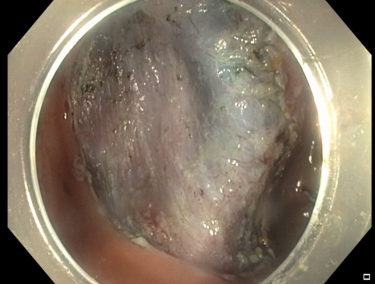 Mohamed Othman (@endoscopyothman) on Twitter photo We’re excited to launch the ESD, Transluminal, and Third Space Endoscopy Fellowship at Baylor College of Medicine, led by <a href="/GiJawaid/">Salmaan Jawaid, MD</a>.
Focus: ESD & POEM, with optional TIF and Bariatric Endoscopy exposure.
Mentors: <a href="/GiJawaid/">Salmaan Jawaid, MD</a>, <a href="/KeihanianTara/">TaraKeihanian MD. MPH.</a>, <a href="/FaresAyoubMD/">Fares Ayoub</a>, and Dr. Mohamed Othman; We’re excited to launch the ESD, Transluminal, and Third Space Endoscopy Fellowship at Baylor College of Medicine, led by <a href="/GiJawaid/">Salmaan Jawaid, MD</a>.
Focus: ESD & POEM, with optional TIF and Bariatric Endoscopy exposure.
Mentors: <a href="/GiJawaid/">Salmaan Jawaid, MD</a>, <a href="/KeihanianTara/">TaraKeihanian MD. MPH.</a>, <a href="/FaresAyoubMD/">Fares Ayoub</a>, and Dr. Mohamed Othman;