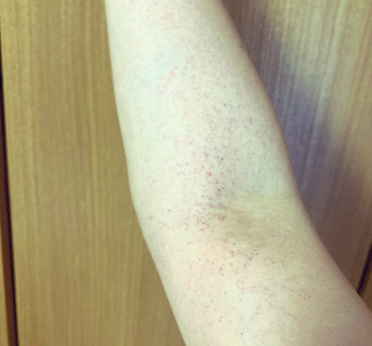 518yavi's tweet photo. 右腕に痛くも痒くもない謎の発疹？皮下出血？あるけどこれは何？
昨日からの頭痛と関係あるのかないのか
内科なのか皮膚科なのか https://t.co/iUMbHnlYzf