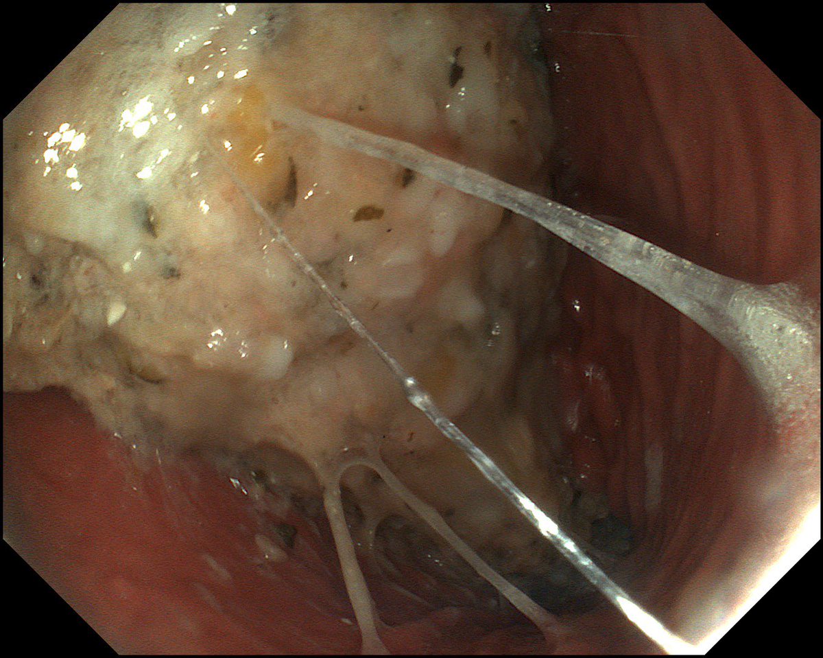 manolo2002sv's tweet photo. Gastroparesia severa (parálisis gástrica) inducida por Ozempic . https://t.co/jrbt8dEeCI