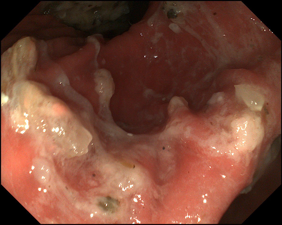 manolo2002sv's tweet photo. Gastroparesia severa (parálisis gástrica) inducida por Ozempic . https://t.co/jrbt8dEeCI