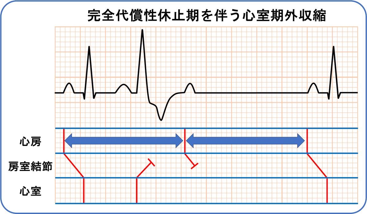 完全代償性休止期を伴う心室期外収縮