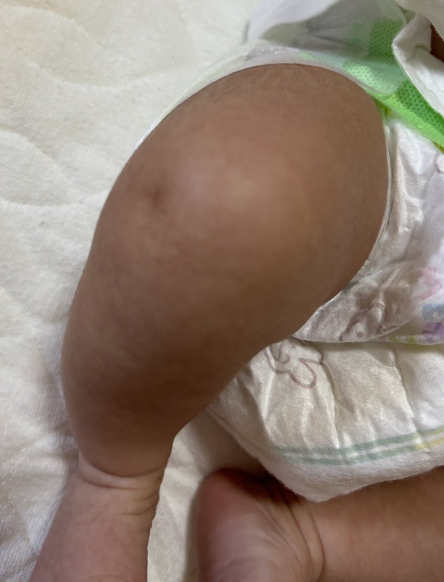 Design_aaaara's tweet image. 5週間の神戸滞在折り返し
子守と晩ご飯作り担当👵

4wだった赤さんはまる〜くなってきた👶

あやすのがお仕事って喜んできたけど、意味不明のギャン泣きは
ばばも泣きたいwww

息子しかいないから
孫は抱けないのかなって思ってたけど
こんなに抱っこさせてもらえて
感謝しかない

むちむちお膝エクボ