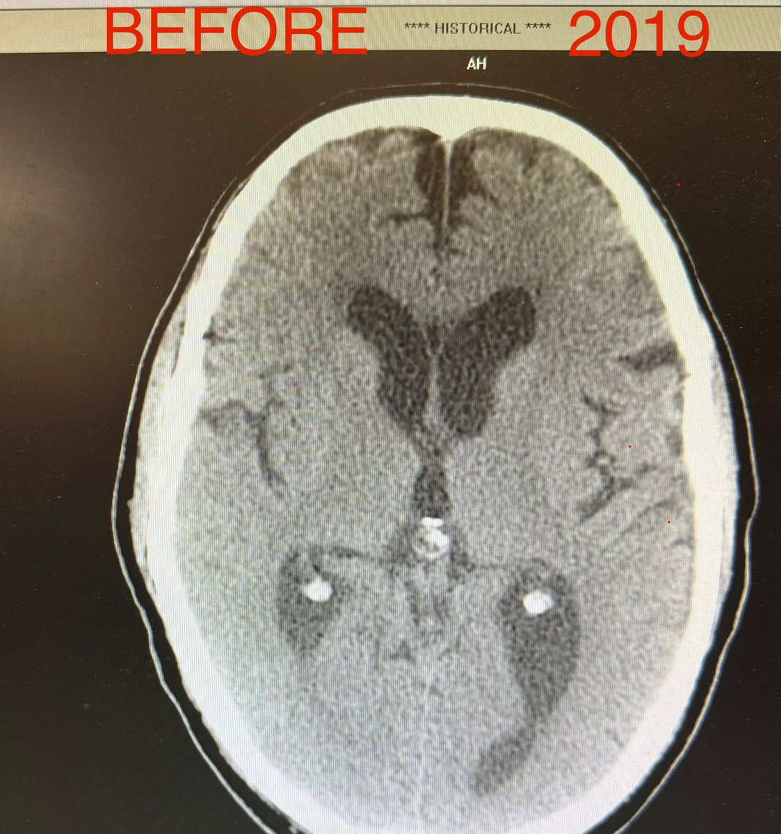 MeasslainteIRL's tweet image. Simon Harris pushed an experimental LNP–mRNA technology onto a low-risk youth population, under coercive conditions and without true informed consent.

The fallout:

Disability &amp;amp; neurological damage in many recipients.

Brain scans show atrophy 3–10× faster than normal aging.