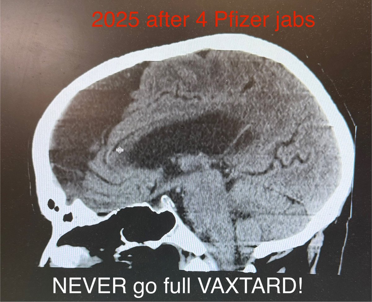 MeasslainteIRL's tweet image. Simon Harris pushed an experimental LNP–mRNA technology onto a low-risk youth population, under coercive conditions and without true informed consent.

The fallout:

Disability &amp;amp; neurological damage in many recipients.

Brain scans show atrophy 3–10× faster than normal aging.