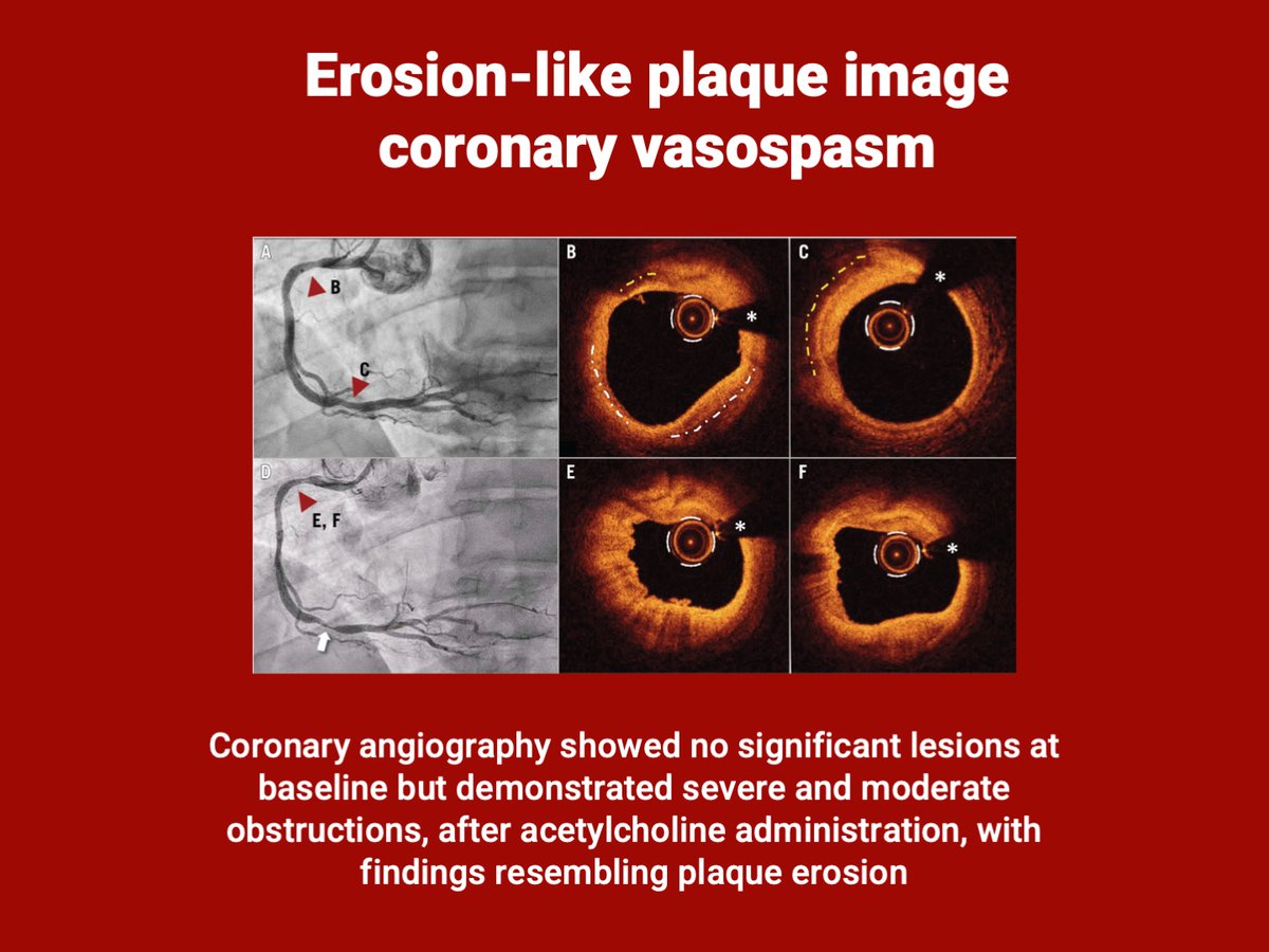 A rare OCT finding captured after acetylcholine-induced spasm, resolving with nitroglycerine. <a href="/teresabastante/">Teresa Bastante</a>
📖 Read the full case here 👇 eurointervention.pcronline.com/article/erosio…