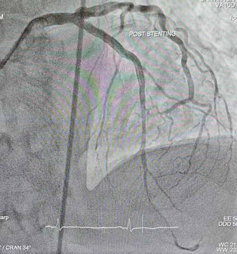 drkltan's tweet photo. Introducing 1st🥇Successful #LithiX (#IntravascularLithotripsy, #IVL) and Bioadaptive #Angioplasty with #DynamX #Bioadaptor System by #Elixir in #NegeriSembilan and Columbia Asia Hospital-#Malaysia🏥 at
KLTan Heart Specialist Clinic- 心脏内科专科 https://t.co/716H8YlOvL
