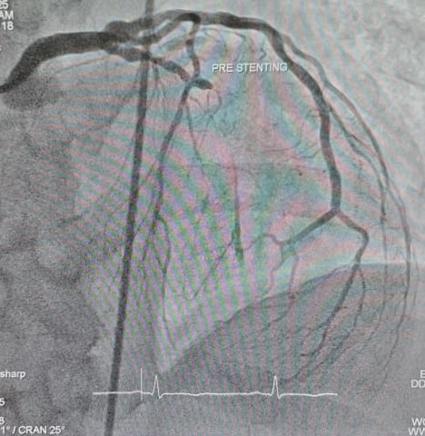 drkltan's tweet photo. Introducing 1st🥇Successful #LithiX (#IntravascularLithotripsy, #IVL) and Bioadaptive #Angioplasty with #DynamX #Bioadaptor System by #Elixir in #NegeriSembilan and Columbia Asia Hospital-#Malaysia🏥 at
KLTan Heart Specialist Clinic- 心脏内科专科 https://t.co/716H8YlOvL