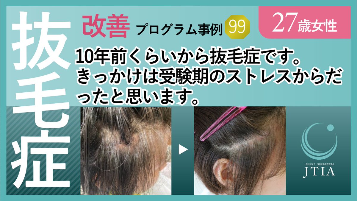tricho_jtia's tweet photo. ★抜毛症改善プロセス事例99：27歳女性：きっかけは受験期のストレス。 https://t.co/UHD7L9KYXi @YouTubeより https://t.co/njoMEewbpl