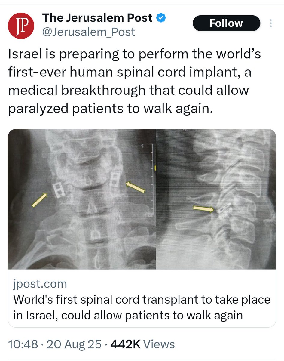 MabelPajarita's tweet photo. Israel pelea por su supervivencia y se las arregla para hacer el mundo: està cerca de hacer caminar paralíticos. 
RESPECT.
Y hay que aguantar a los retardados del Free Palestine que piden a sus gobiernos que corten colaboración con la ciencia israelí. https://t.co/6t8HhHEK7x