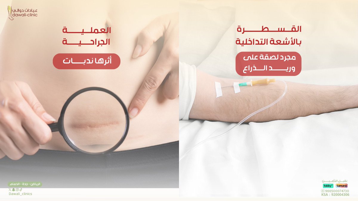 عيادات دوالي
 المعنى الحقيقي للتقنية الطبية الحديثة 
نقدم العلاج للعديد من الأمراض التي كانت تستدعي الجراحة .. بدون جراحة وبدون تخدير ..

للحجز ☎️
0112005787
او على الواتس اب 
00966500074730

📍موقع العياده 
(الرياض -جدة -الدمام )عيادات_دوالي 
 #الياف_الرحم #عيادات_دوالي #صحه