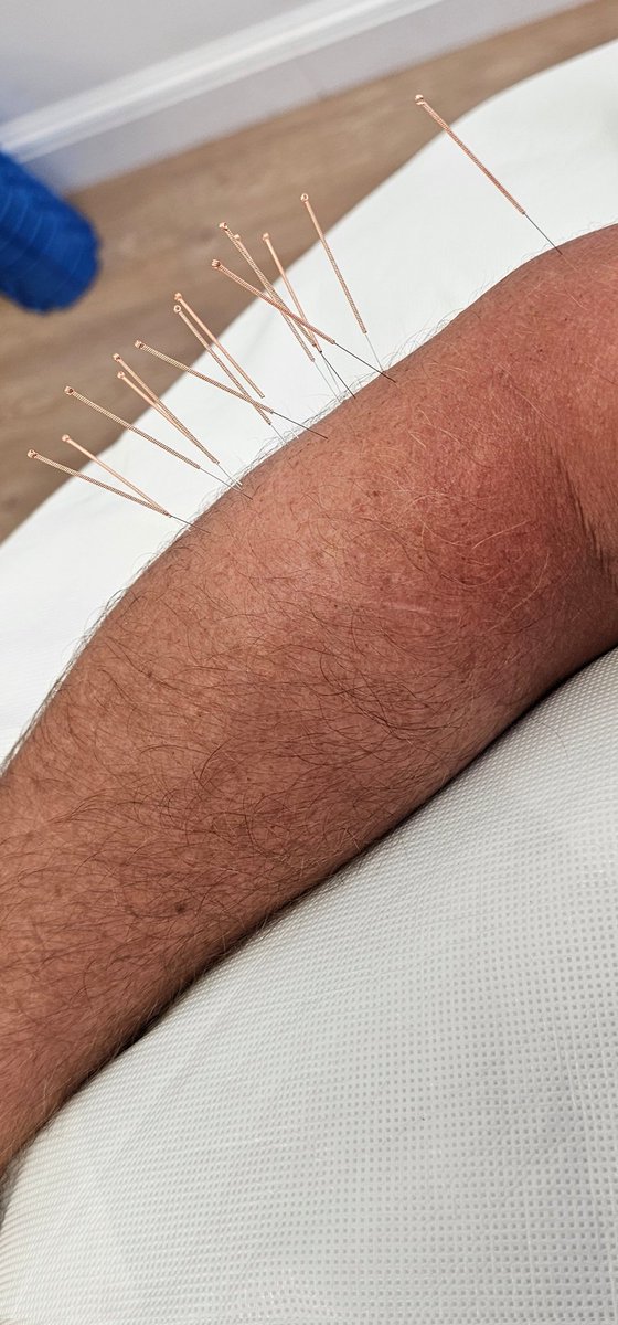 Craig Lee (@craiglee337) on Twitter photo On the run up to the <a href="/PGAScotland/">PGAScotland</a> Ramsden currency Scottish Championship <a href="/ScotscraigGC/">Scotscraig Golf Club</a>, another needling session to help ease the tennis elbow <a href="/StirlingPhysio/">MacFarlane Physio</a> On the run up to the <a href="/PGAScotland/">PGAScotland</a> Ramsden currency Scottish Championship <a href="/ScotscraigGC/">Scotscraig Golf Club</a>, another needling session to help ease the tennis elbow <a href="/StirlingPhysio/">MacFarlane Physio</a>