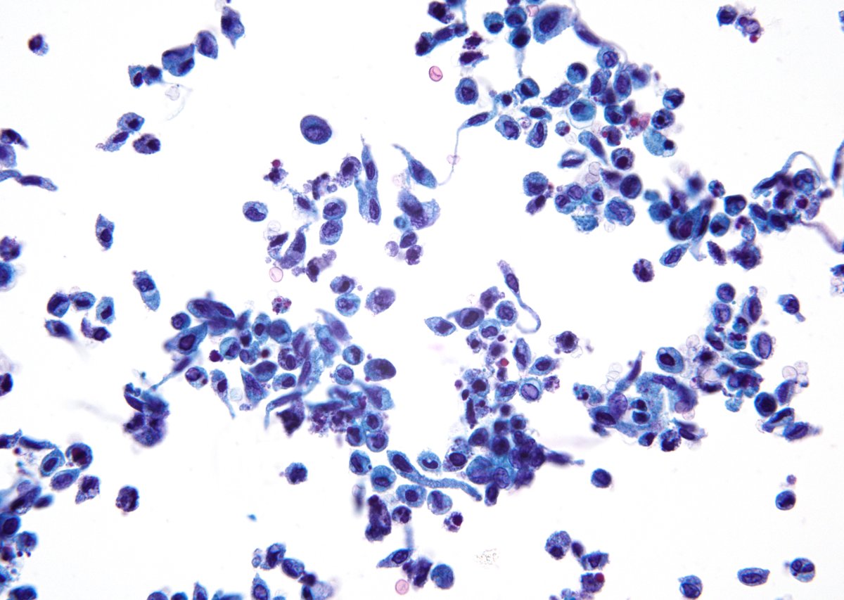 sza_jhcyto's tweet photo. "Comet Tails or Cercariform" cells: High-grade Urothelial Carcinoma in a voided urinary specimen. (ThinPrep) https://t.co/6TPW9dZZkE
