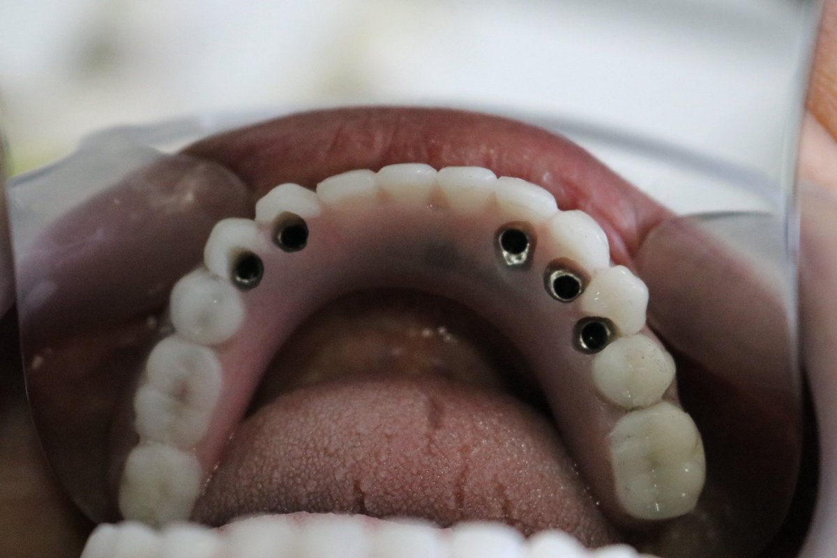 freimplant's tweet photo. Instalación de prótesis híbrida soportada en 4 implantes. https://t.co/jwrX1G5TKJ