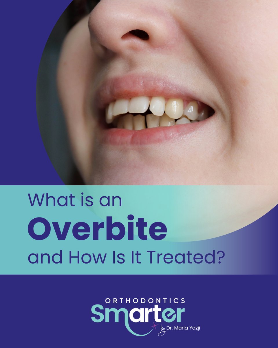 DrYazjiOrtho's tweet image. An overbite isn’t just a cosmetic issue; it can affect how you chew, speak, and smile. Learn how braces or Invisalign® can correct it and bring your bite into balance. 🦷
smarterorthodontics.com/what-is-an-ove…
#Overbite #InvisalignExpert #SmarterOrthodontics #DrMariaYazji #orthodontics