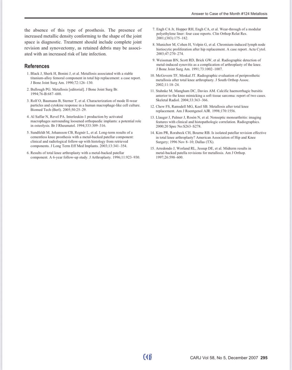 #TBT to a 2007 #casereport in the CARJ by Drs Leswick, Kraushaar, Gourgaris &amp; Harder on knee joint #metallosis after #arthroplasty . The spacers had failed with contact of metal components resulting in foreign body reaction with synovial proliferation incl metallic deposition.