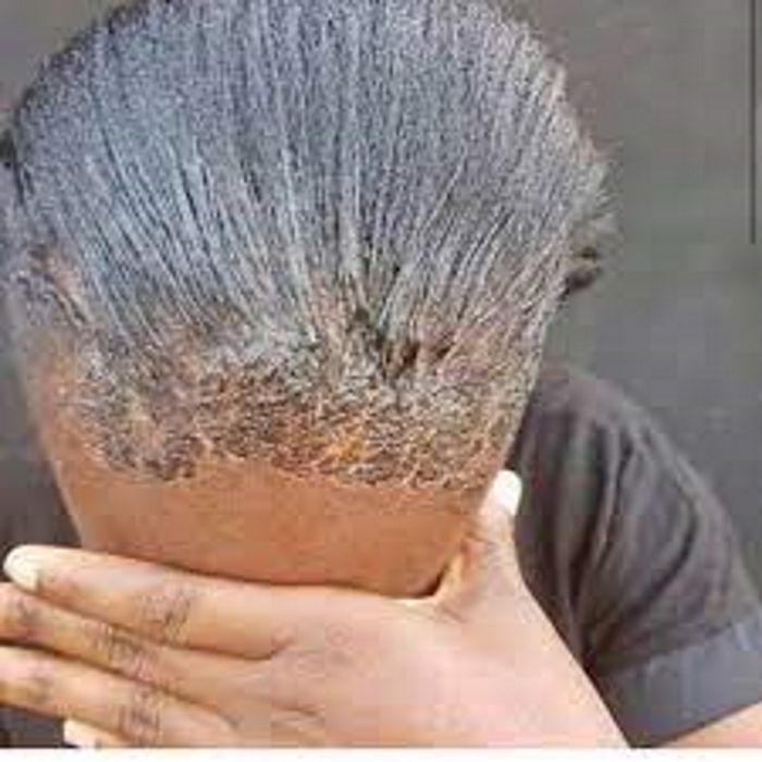 Hair relaxer injuries can result from chemical burns and scalp damage. Make sure you seek legal advice for damages
hearnlawfirm.net 
#lawfirm #lawyer #legalproblem #HairRelaxerInjury #RelaxerDamageAwareness #RelaxerInjuryHelp #HairTreatmentRecovery