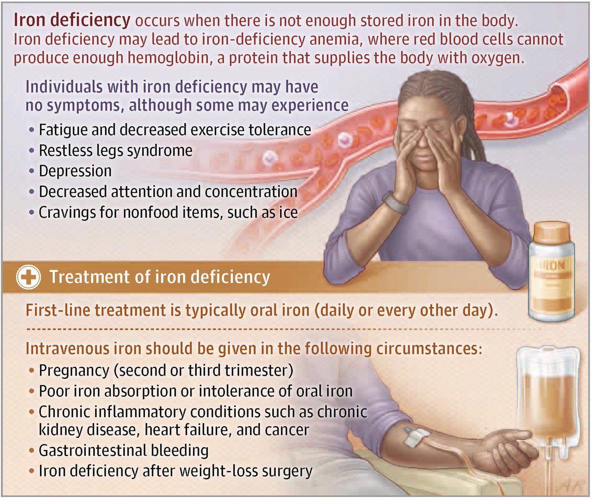 🩸 Iron deficiency occurs when the body does not have enough stored iron. 

Worldwide, about 2 billion people have #irondeficiency and 1.2 billion people have iron-deficiency #anemia. 

Learn more in this JAMA Patient Page: ja.ma/45X8gsG