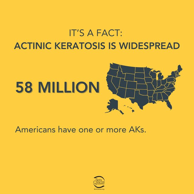 SkinCancerOrg's tweet image. Actinic keratosis (AK) is more than just a rough patch on your skin — it’s a warning sign. These pre-cancerous spots can lead to skin cancer if left untreated. Early detection and protection from the sun are key. skincancer.org/skin-cancer-in… #ActinicKeratosis #EarlyDetection