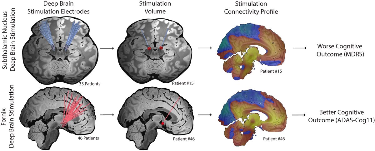 calvinwhow's tweet image. New research from @harvardmed
@brighamWomens
@brain_circuits: 
We evaluated how DBS in Parkinson’s with Alzheimer’s influences cognition. Originally, it looked like DBS was deleterious for cognition in Parkinson’s, but could be beneficial in Alzheimer’s.